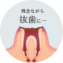 残念ながら抜歯に･･･