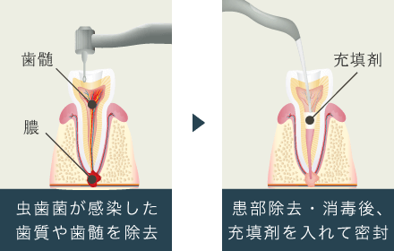 虫歯菌が感染した歯質や歯髄を除去→患部除去・消毒後、充填剤を入れて密封